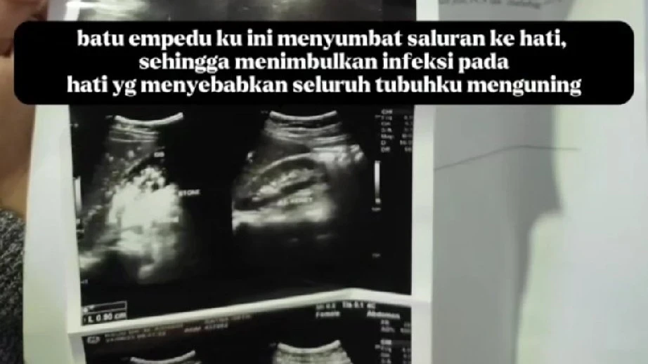 #CeritaInspiratif Makan Sehat Saja Tidak Cukup